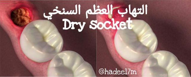 التهاب العظم السنخي Dry Socket Caramella